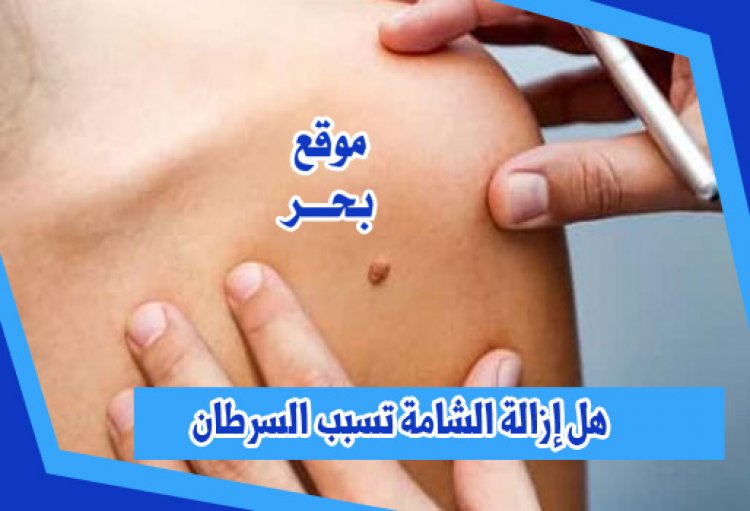 هل إزالة الشامة تسبب السرطان